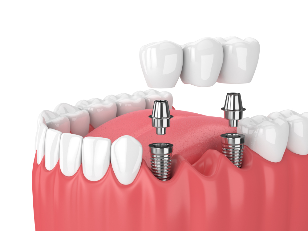 stock-photo--d-render-of-jaw-and-implants-with-dental-bridge-over-white-background-1050054875