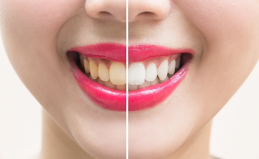 stock-photo-woman-teeth-before-and-after-dental-treatment-teeth-whitening-happy-smiling-woman-dental-health-754146658