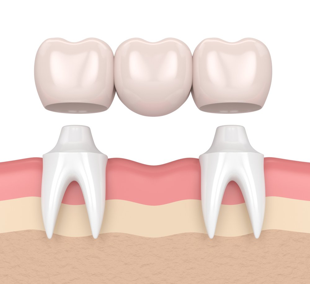 stock-photo--d-render-of-dental-bridge-with-dental-crowns-in-gums-1008624880