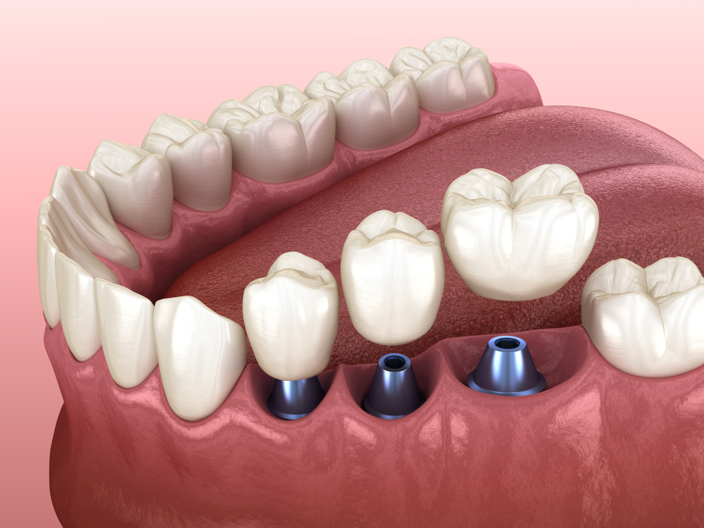 stock-photo--tooth-crowns-placement-over-implants-concept-d-illustration-of-human-teeth-and-dentures-1494042968
